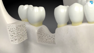 What Is A Dental Bone Graft