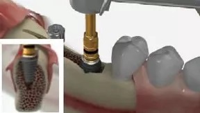 کیت بون اکسپندر MegaGen - Bone Ex Kit