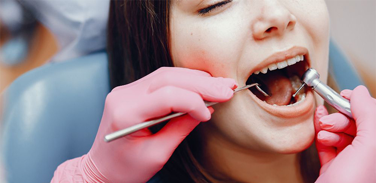 جرم گیری دندان