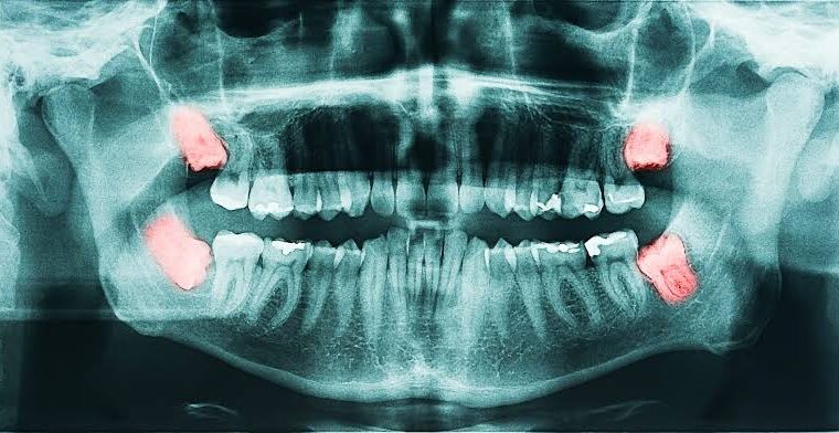 آیا استفاده از آنتی‌بیوتیک‌ها در جراحی دندان‌های عقل ضروری است؟
